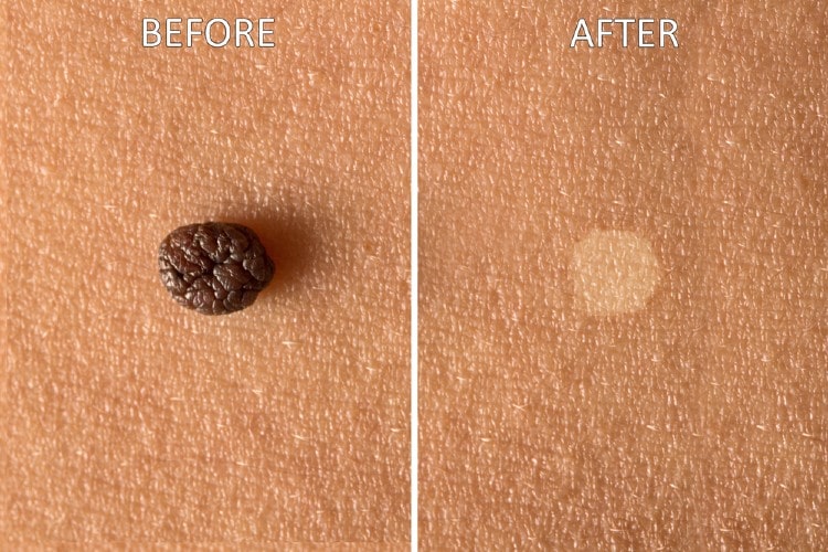 Dermaclear Reviews - Advanced Mole & Skin Tags Removal