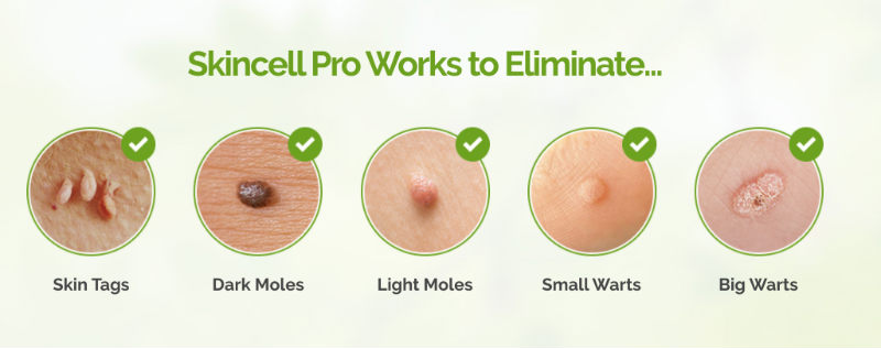Wart Removal Skin Tag Removal Mole Removal - Celebrity Home Mole & Skin Tag Removal System Revealed 5 Skin Tag Removal Mole Removal
