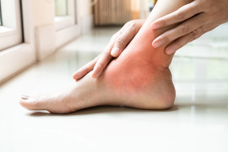 psoriatic arthritis foot pain