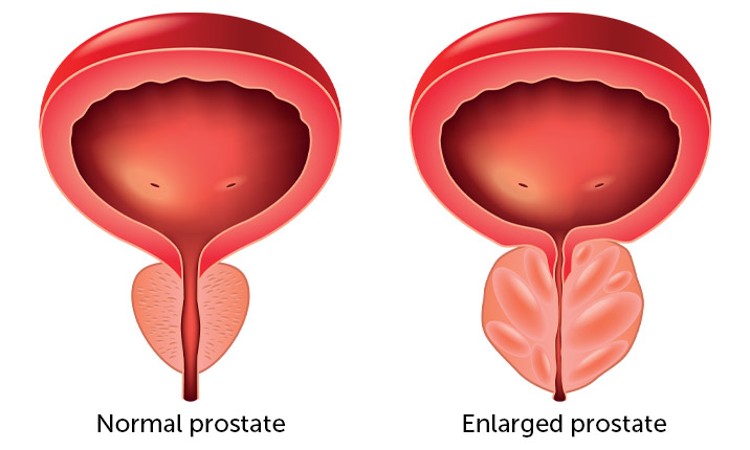 How to shrink an enlarged prostate quickly watch video