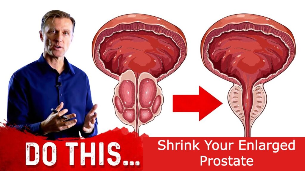 Does Prostodin Really Work For Enlarged Prostate? Honest Consumer Experience