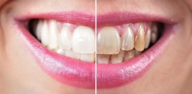 teeth whitening kits snow whiten teeth