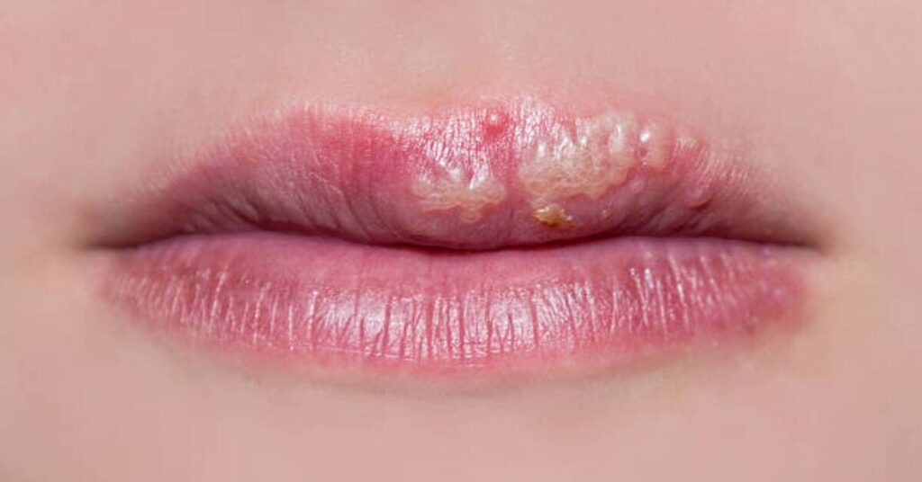 What Causes Cold Sores