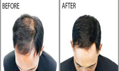 Best Hair Regrowth Treatment for Men - Restored Confidence: A Deep Dive into Effective Hair Regrowth Treatments for Men