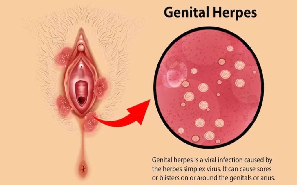 Genital Herpes Medication Over the Counter