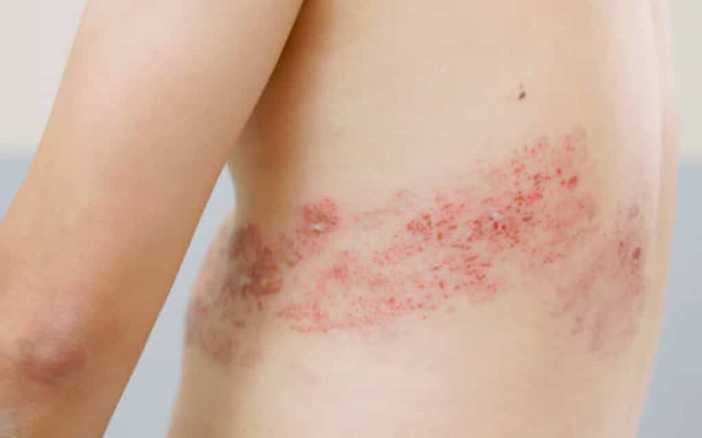 how to heal herpes sores faster How Does Herpesyl Work? 