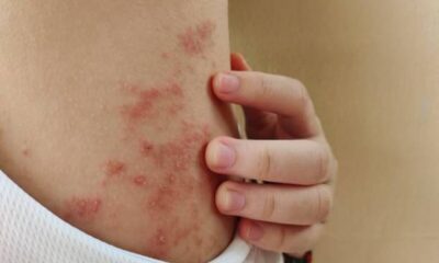 how to get rid of herpes Simplex Virus - Revealed How does Herpesyl supplement work?