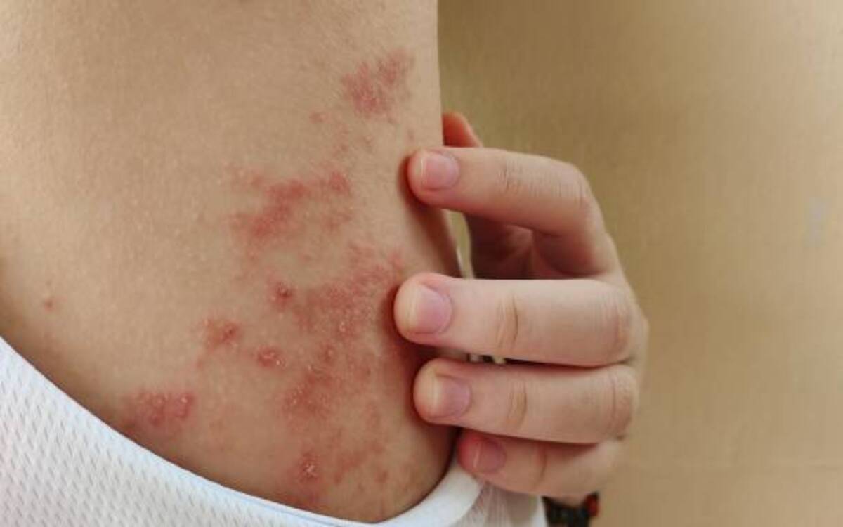 how to get rid of herpes Simplex Virus - Revealed How does Herpesyl supplement work?