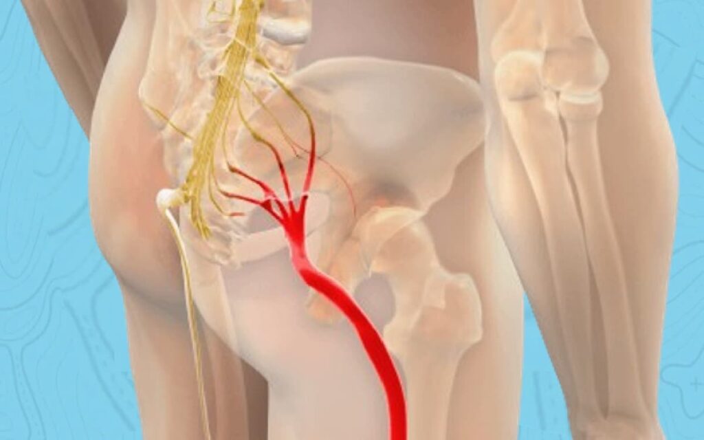 Tired of Agonizing Sciatica? - Say Goodbye to Sciatica Nerve Pain Misery in Just 5 Minutes