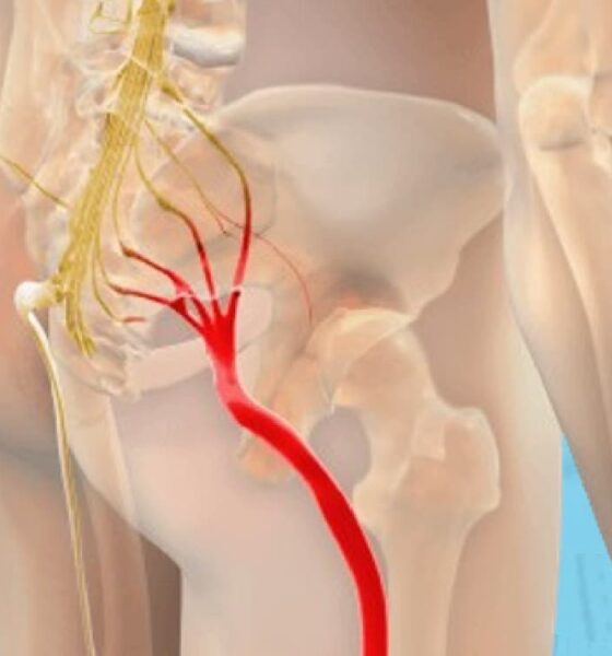 Tired of Agonizing Sciatica? - Say Goodbye to Sciatica Nerve Pain Misery in Just 5 Minutes