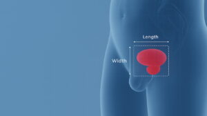 How to measure prostate volume without ultrasound