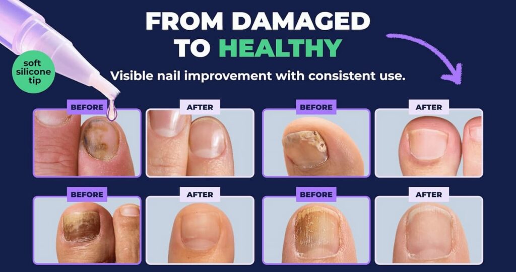 Oroville Nail Fungus Pen Review: Honest Results, Safety & Pricing 7 Is Oroville Nail Fungus Pen a Scam or Legit? (Honest Investigation)