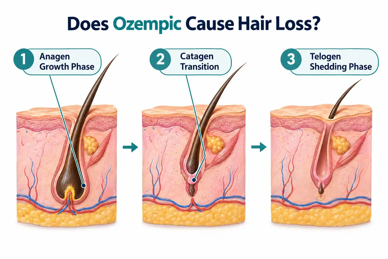 Does Ozempic Cause Hair Loss? Why It Happens & How to Stop It 2 Why does Ozempic cause hair loss