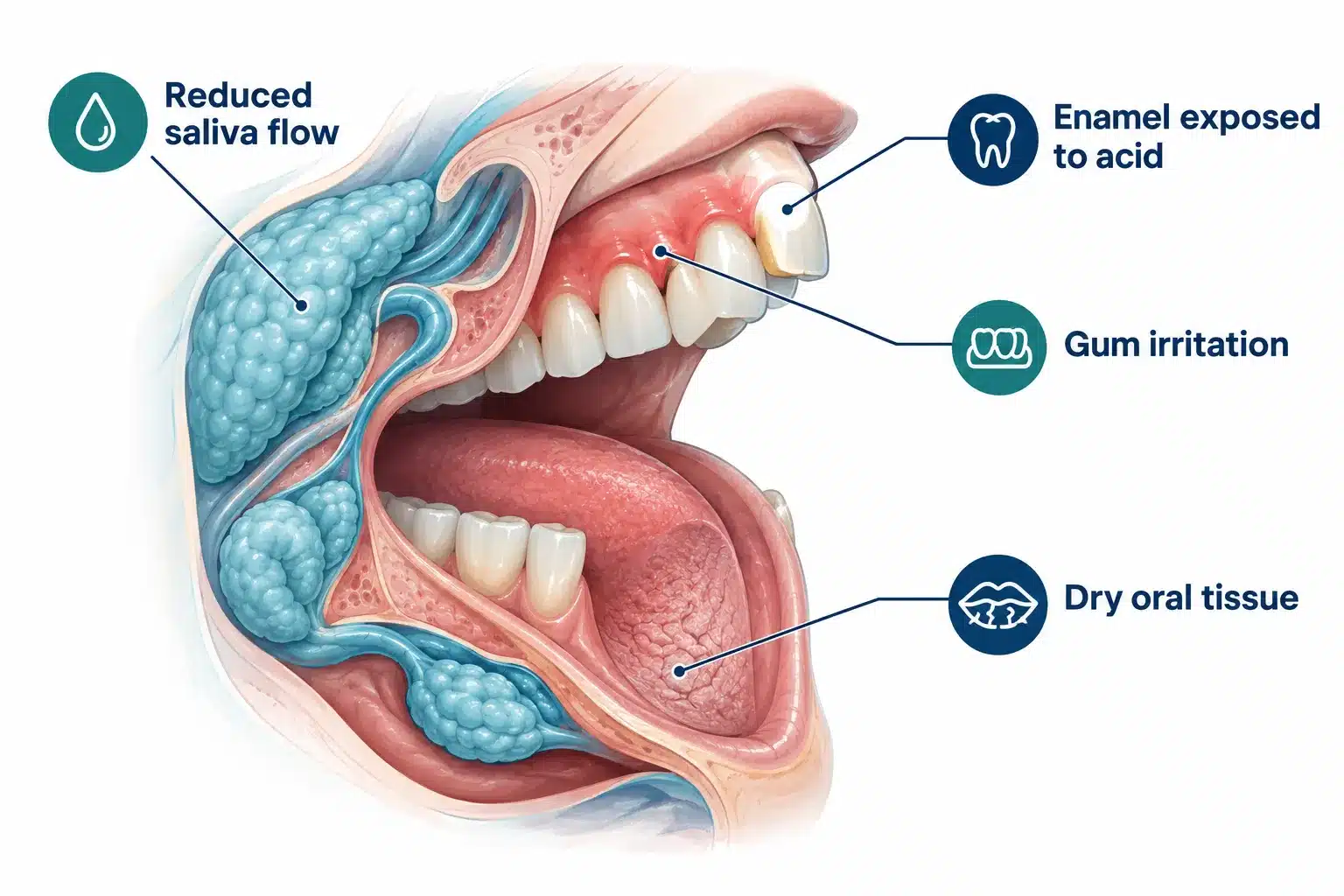 Ozempic Teeth & Mouth: Dental Side Effects Explained 2 Why Does Ozempic Cause Tooth Decay and Cavities